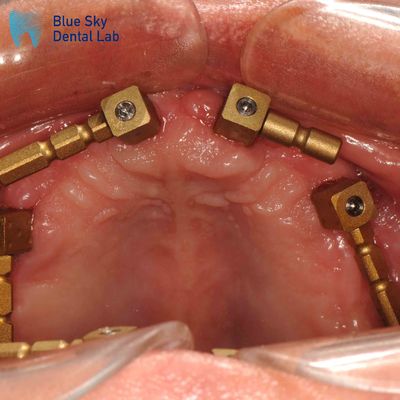 satın al Altın Titanyum Multi Unit Scan Body CAM Sistemi Dentium Scan Body online manufacture
