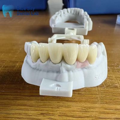 satın al Yüksek şeffaflıklı katmanlı zirkonya taçları implant taçlı doğal online manufacture