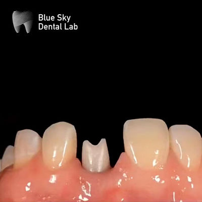 satın al Hipoalerjenik Diş İmplantı Zirkonya Abutment Biyolojik Uyumlu online manufacture