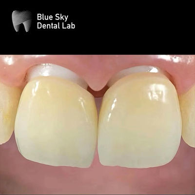 satın al Katmanlı Zirkonya İmplant Tacı Zirkonya Abutment Biyolojik Uyumlu online manufacture
