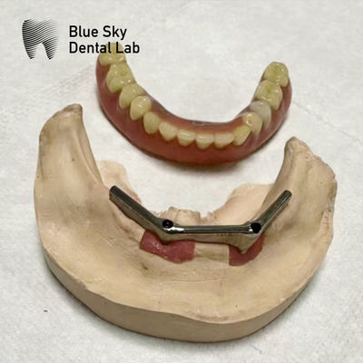 satın al Dental implantı çıkartılabilir protez ile titanyum çubuk diş implantı online manufacture