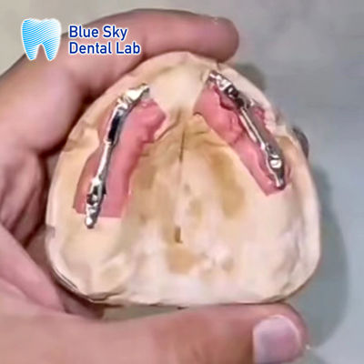 satın al Çıkarılabilir Dental İmplant Titanyum Çubuk Segmentasyon Mavi Gökyüzü İmplantı online manufacture
