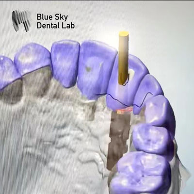 satın al Kumlu ASC Abutment Saf Titanyum açılı vida kanalı abutment online manufacture