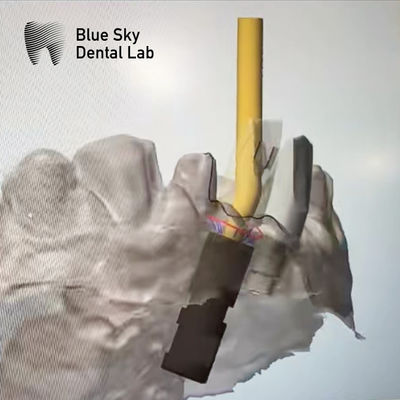 satın al Ti Temel vida tutulmuş abutment implant açılı vida kanalı abutment online manufacture