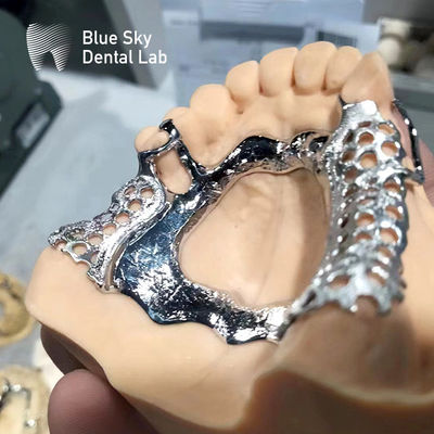 satın al Mavi Gökyüzü Diş Çerçevesi Kısmi Çene Diş Dentüsü dökme metal çerçeve online manufacture