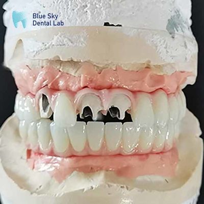 Titanyum Malo Köprüsü İmplant Köprüsü Çoklu Birimli Abutment Olmayan Cementable