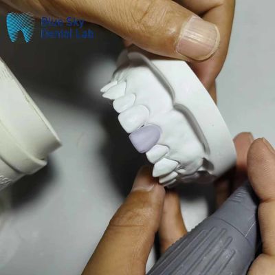 0.3mm ince cam seramik kaplama implantları hafif kaplama kabukları