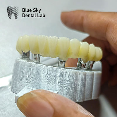 Yumuşak yüzey yerleştirme senaryoları için PMMA köprü implant kesesi