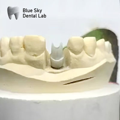 Estetik Zirkonya Abutment İmplantı Biyokompatible Precision Milled