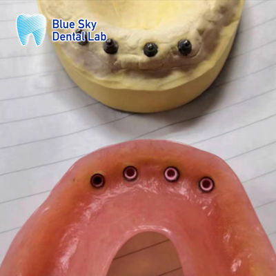 Çıkarılabilir İmplant Restorasyon Yerlendirici İmplant Diş Dentüsü Tam Ağız Restorasyonu