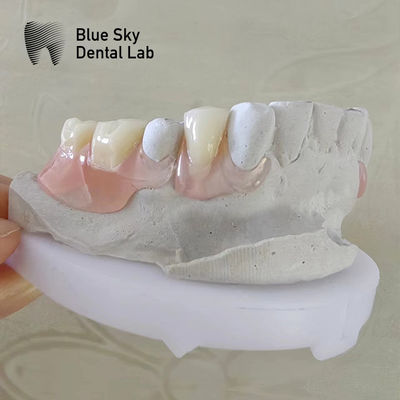 Doğal Gülümseme Diş Valplast Diş Dişleri Fleksif Valplast Alınabilir Kısmi Diş Dişleri