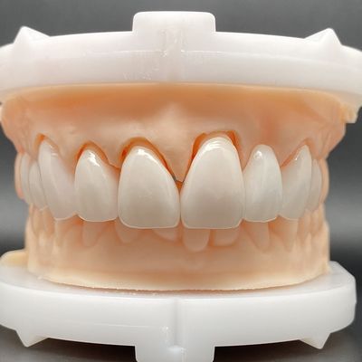 EMax Finer Kağıtları Çoklu Renklerde Pasif Uygulama En Az Diş Hazırlığı ile Güzel Gülümseme Yapın
